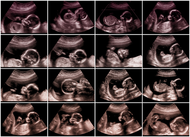Collage de 16 imágenes de ultrasonografía fetal
 - Foto, imagen