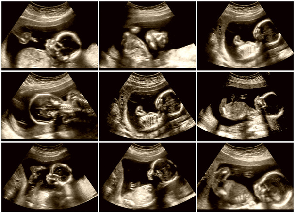 Nove immagini di ultrasonografia del feto
 - Foto, immagini