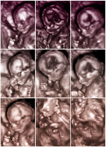 Série de neuf images d'échographie foetale 3D
 - Photo, image