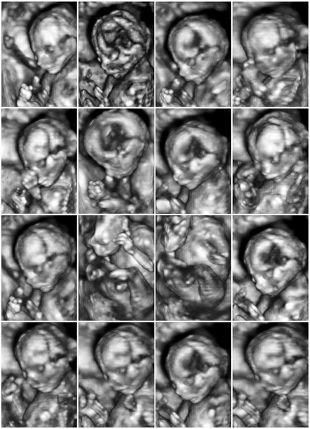 Collage of 16 medical images of 3D ultrasound anomaly scan on a  - Photo, Image