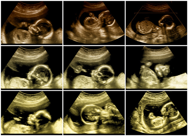 Series of 9 fetal sonograms pictures - Photo, Image