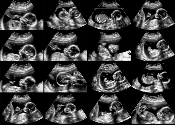 Συλλογή από υπερηχογράφημα έμβρυο σαρώσεις  - Φωτογραφία, εικόνα