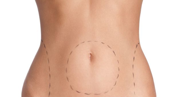 Belly plastic correction - Photo, Image