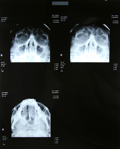 sinüs röntgen - Fotoğraf, Görsel