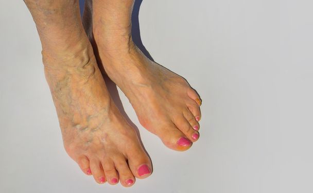 Spataderen op een vrouwelijke benen - Foto, afbeelding