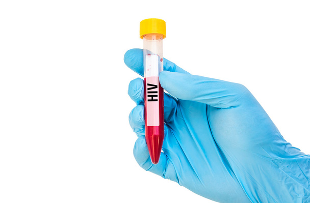 Tubo de ensayo con muestra de sangre para VIH
 - Foto, imagen