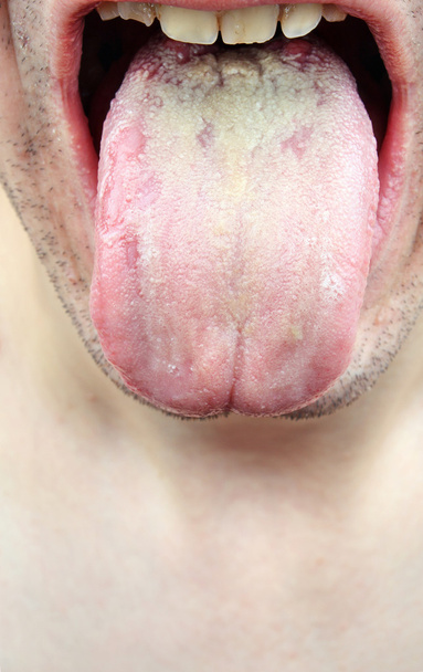 Bakteriyel bir enfeksiyon hastalığı dil - Fotoğraf, Görsel