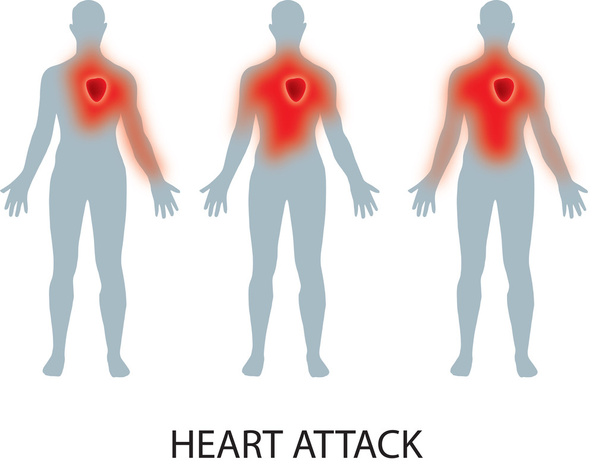  心臓発作のベクトル - 写真・画像