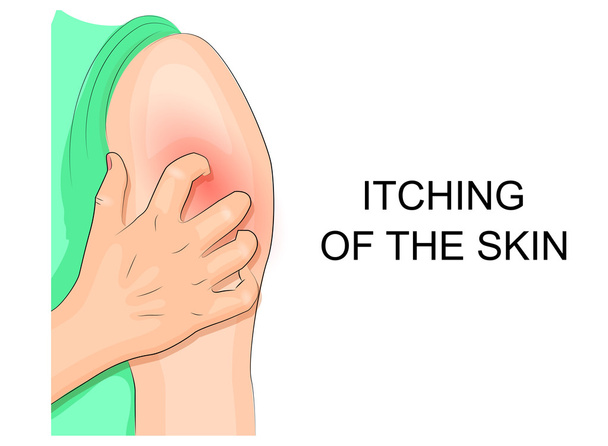 itching of the skin, infection. hand combing shoulder - Vector, Image