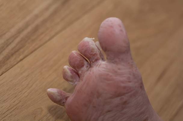 El pie derrama su piel - enfermedad cutánea de primer plano
 - Foto, imagen