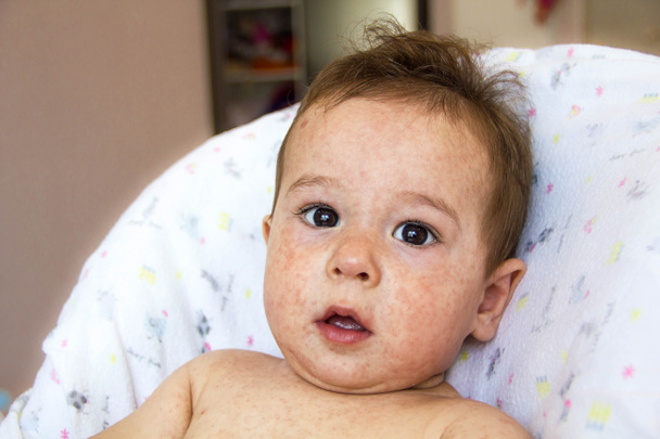 baba dermatitis probléma a kiütés. Allergiában szenved Élelmiszerallergiákban. Közelkép atópiás tünet a bőr arc. koncepció - Fotó, kép