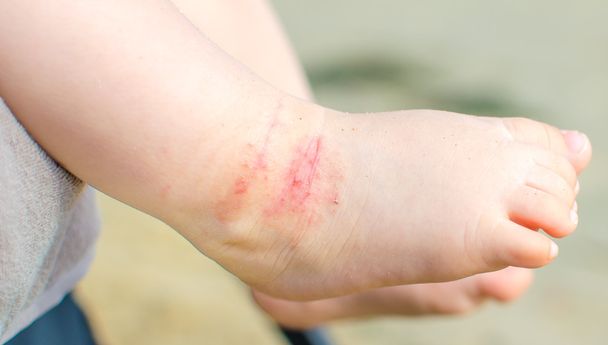 dermatitis picante pie de bebé atópico
 - Foto, Imagen