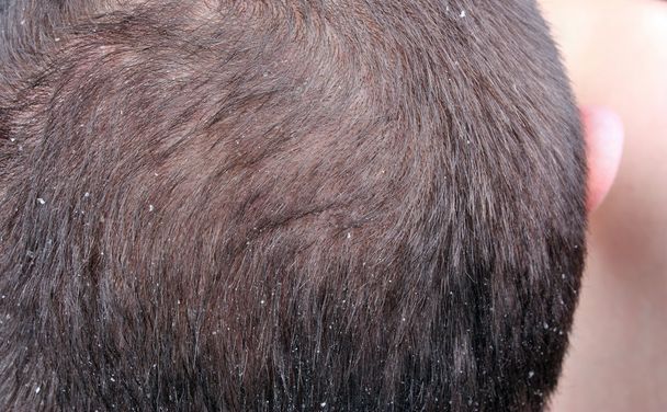 kepek saç - Fotoğraf, Görsel