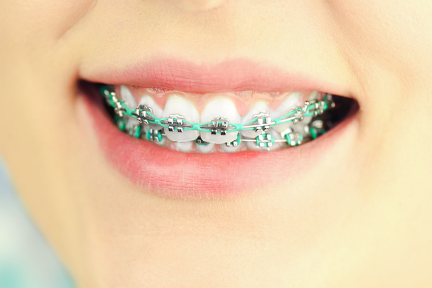 Beauté femme sourire avec des accessoires ortodontiques. Traitement orthodontique
. - Photo, image