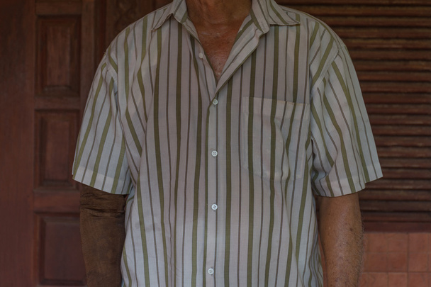 Ásia homem idoso com um braço e braço prótese
 - Foto, Imagem