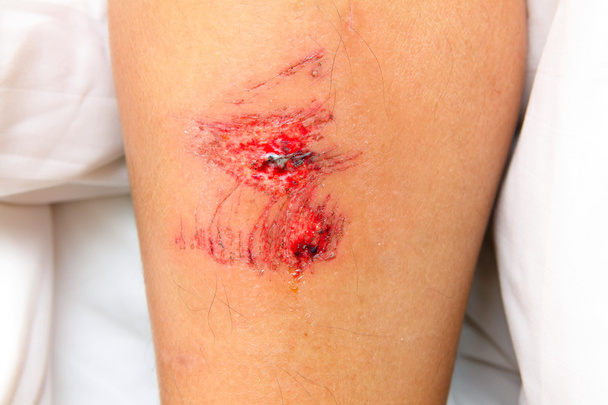 Рана на ноге
 - Фото, изображение