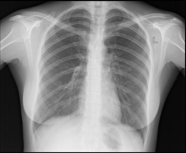 Une radiographie pulmonaire
 - Photo, image