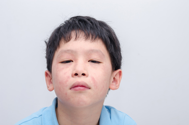 Genç Asyalı çocuk döküntü ile yüzü - Fotoğraf, Görsel