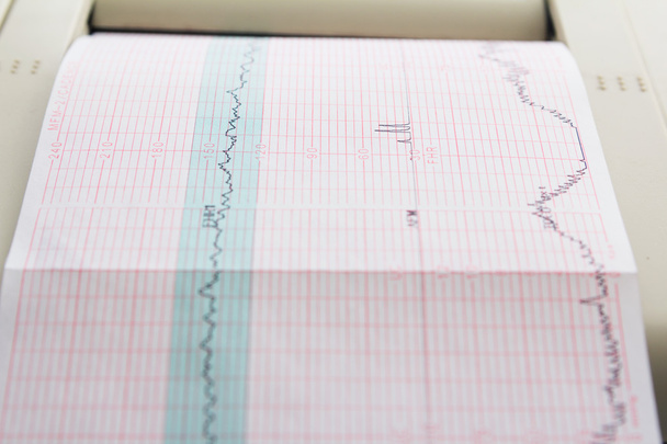 Druck des Kardiogrammberichts aus dem Elektrokardiographen auf der Geburtsstation - Foto, Bild