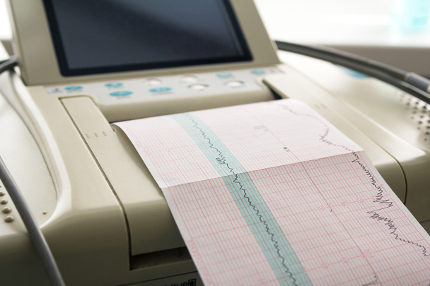 Распечатка отчета кардиограммы с электрокардиографа в родильном отделении
 - Фото, изображение