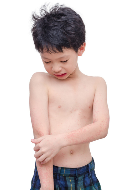 boy screatching his arm with rash over white - Photo, Image