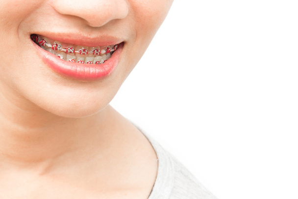 Close up woman smiling with Ceramic and Metal Braces on white background, beauty and healthy concept - Photo, Image