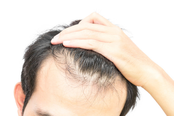 Closeup νεαρό άνδρα σοβαρό πρόβλημα της τριχόπτωσης για έννοια απώλεια μαλλιών - Φωτογραφία, εικόνα
