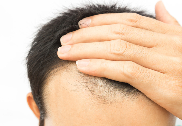 Молодой человек серьезная проблема выпадения волос для концепции выпадения волос
 - Фото, изображение