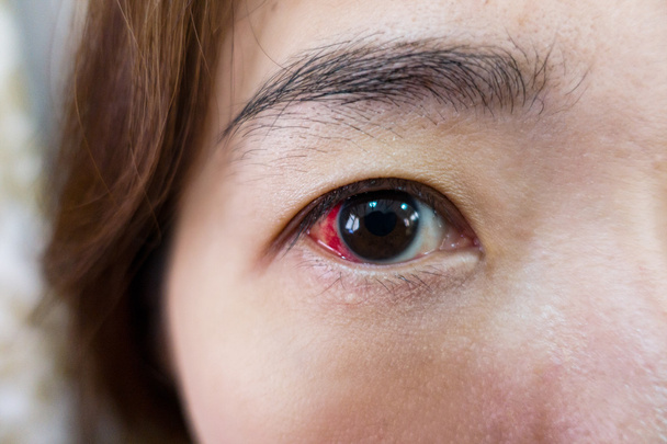 Augenverletzungen oder infiziert für ein gesundes Konzept, Makro-Nahaufnahme - Foto, Bild