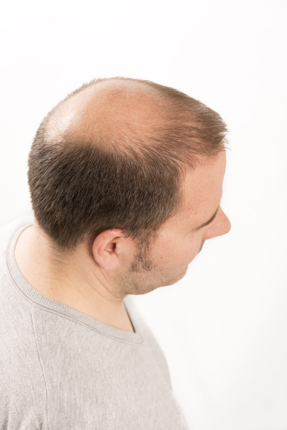 Senior man and hair loss issue - 写真・画像