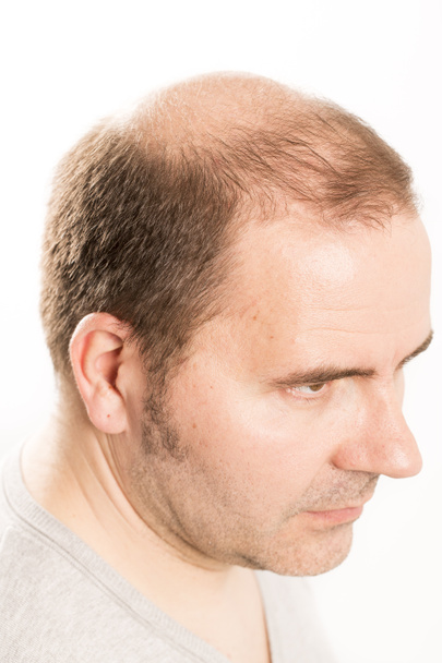 Senior Mann und Haarausfall Thema - Foto, Bild