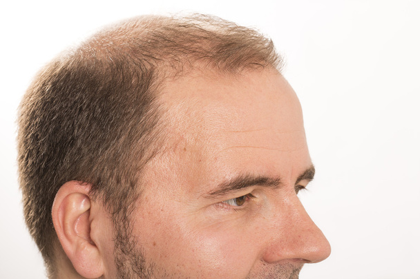 Hombre mayor y problema de pérdida de cabello
 - Foto, imagen
