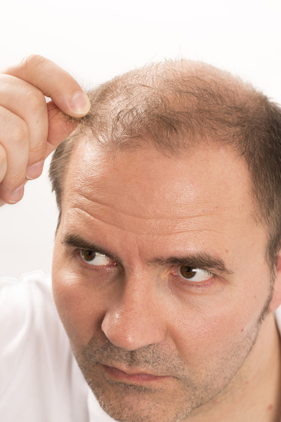 Hombre mayor y problema de pérdida de cabello
 - Foto, Imagen