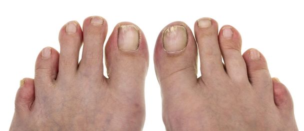Brzydkie paznokcie u nóg  - Zdjęcie, obraz