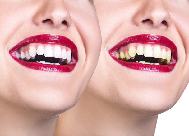 Before and after whitening teeth. - Photo, Image