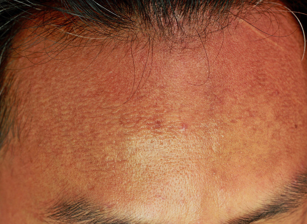 acne voorhoofd, huidtextuur  - Foto, afbeelding