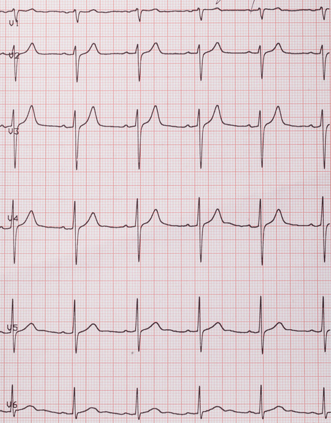 Heart beats cardiogram  - Fotó, kép