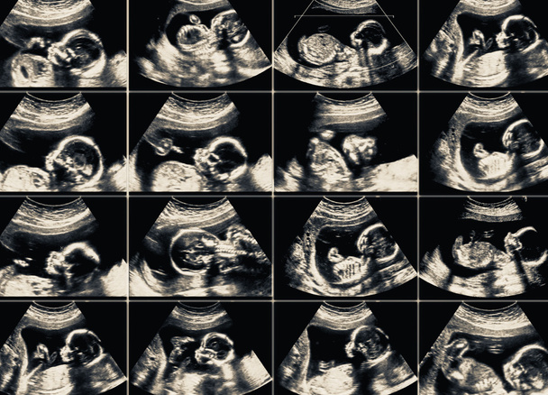 Collage of 16 ultrasonography fetus pictures - Photo, Image