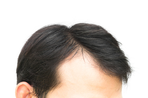 Closeup νεαρό άνδρα σοβαρό πρόβλημα της τριχόπτωσης για μαλλιά απώλεια πρωτότ - Φωτογραφία, εικόνα