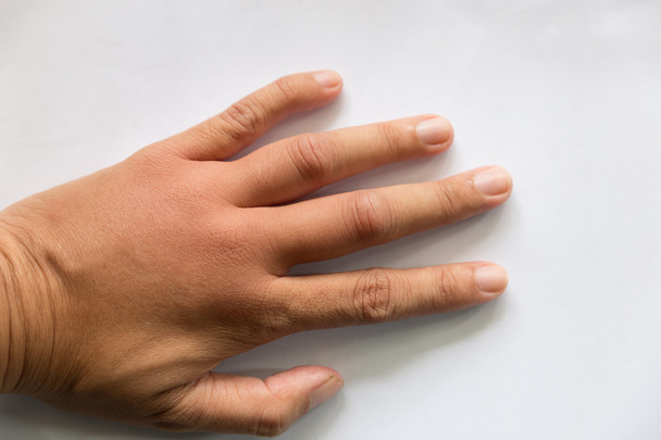 gezwollen hand van wespensteek - Foto, afbeelding