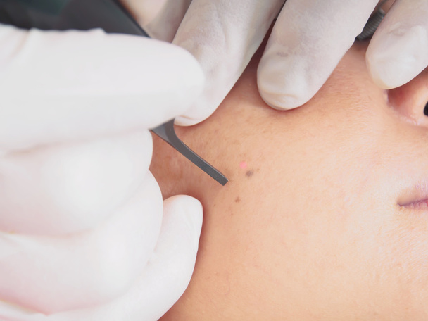 Aziatische vrouw patiënt op laser procedure huid resurfacing in de esthetische geneeskunde. - Foto, afbeelding