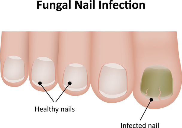 Infección por hongos en las uñas
 - Vector, imagen