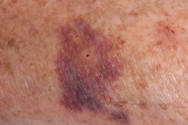 krwiak na ramieniu starszą kobietę - Zdjęcie, obraz