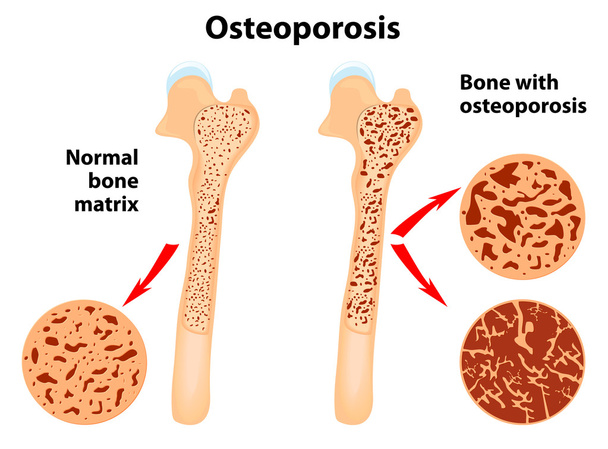 остеопороз
 - Вектор, зображення