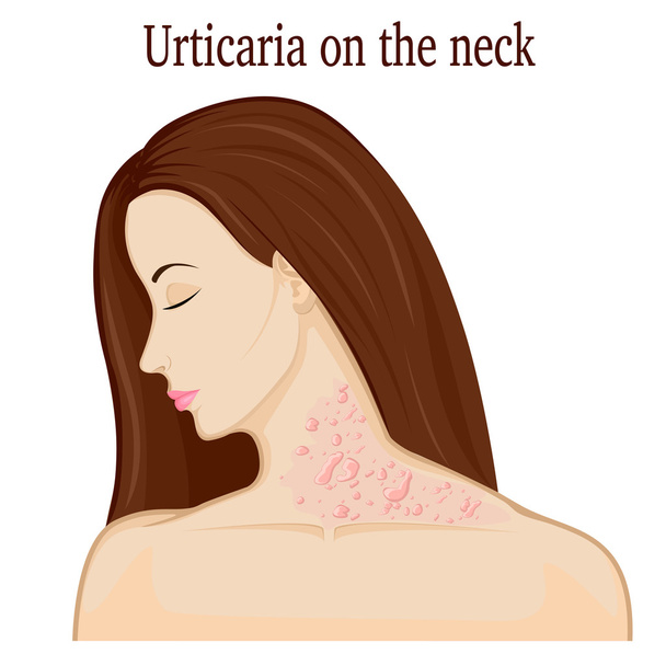 Urticaria on the neck - Vector, Image