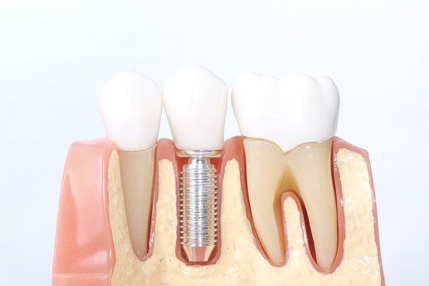 Generic dental teeth model  - Photo, Image