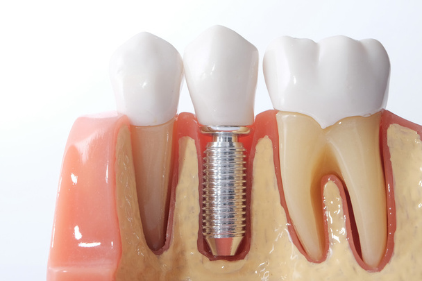 Загальна модель зубів зубів
  - Фото, зображення