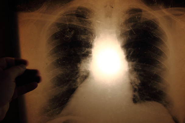 x-ray van longen - Foto, afbeelding