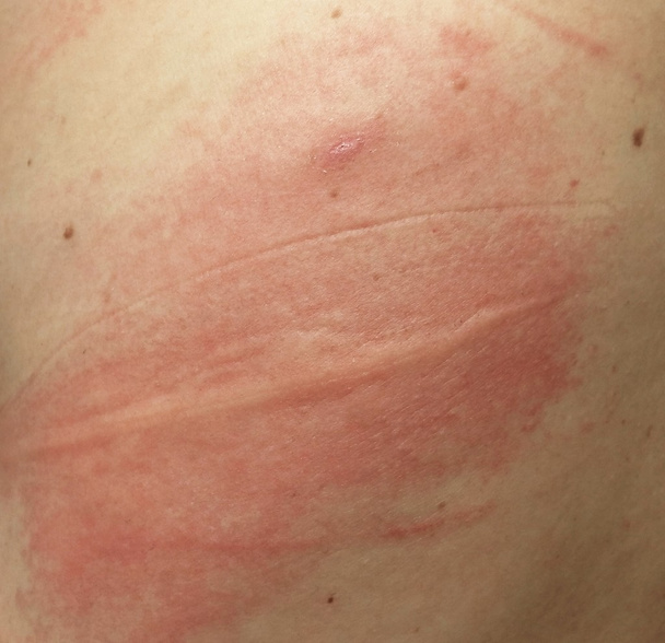 Hautausschlag bei empfindlicher Haut oder Hautproblem mit allergischem Ausschlag - Foto, Bild