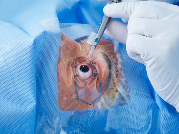 Cirugía ocular de cerca
 - Foto, Imagen